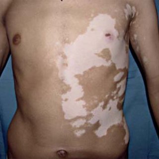 Boy with segmental vitiligo