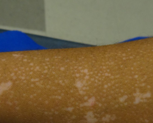 Confetti vitiligo